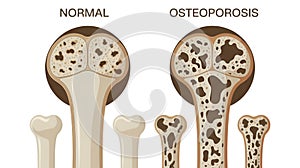 Normal vs. Osteoporosis Bone Structure Comparison