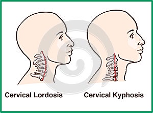Normal vs. Reversal of Cervical Lordosis photo