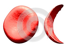 Normal vs Sickle Red Blood Cell photo