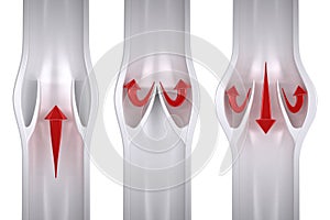 Normal vs Varicose - Vein Anatomy