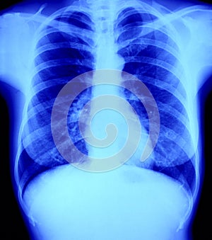 Normal X - ray radiography of chest, lung and hear photo