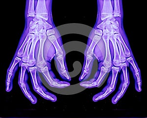 Normal xray of both hands