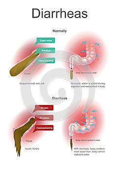 Diarrheas. Normally water is added during digestion and reabsorbed in body. With diarrheas than body cannot reabsorb water. photo