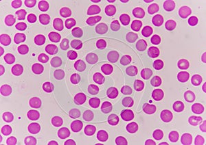 Normochromic normacytic red blood cells