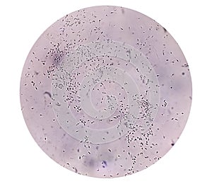 Normozoospermia analyzed by microscope.
