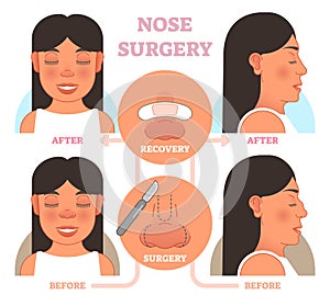 Nose plastic surgery vector illustration.