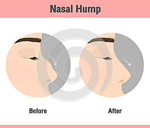 Nose reconstruction or nasal hump removal
