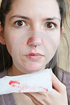Nosebleed, a young woman with a bloody nose. Healthcare and medical concept. Close-up