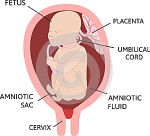 A nuchal cord. the umbilical cord is wrapped around the fetus s neck