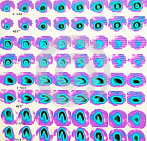 Nuclear myocardial perfusion stress test