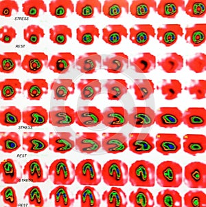 Nuclear myocardial perfusion stress test