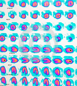 Nuclear myocardial perfusion stress test