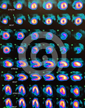 Nuclear myocardial perfusion stress test