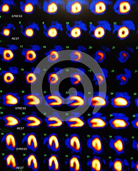 Nuclear myocardial perfusion stress test