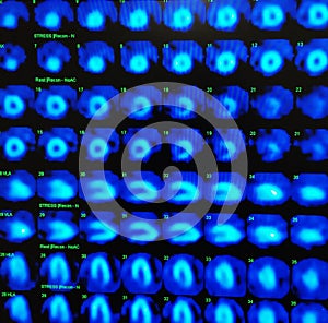 Nuclear myocardial perfusion stress test