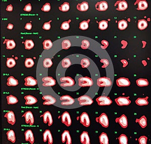 Nuclear myocardial perfusion stress test