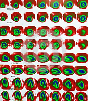 Nuclear myocardial perfusion stress test photo