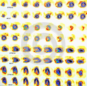 Nuclear myocardial perfusion stress test images