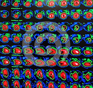 Nuclear myocardial perfusion stress test photo
