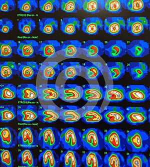 Nuclear myocardial perfusion stress test photo