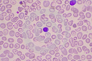 Nucleated Red Blood Cells  NRC in blood smear