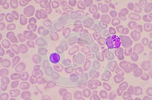 Nucleated Red Blood Cells  NRC in blood smear