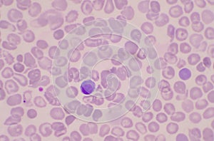 Nucleated Red Blood Cells  NRC in blood smear