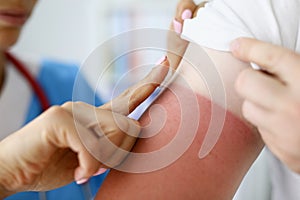 Nurse applying protective cream to skin of hand with burn closeup