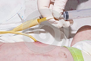 Nurse is feeding through g-tube after gastrostomy of newborn baby in neonatal intensive care unit at children`s hospital