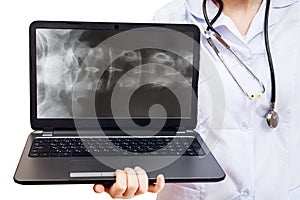 Nurse holds computer laptop with spinal column