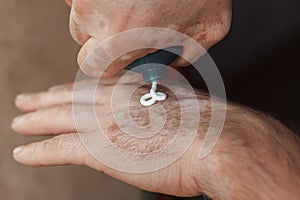 Nurturing hands in Vitiligo Care. Using cream as a treatment