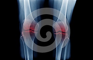 OA knee x-ray image on blue color with black background photo