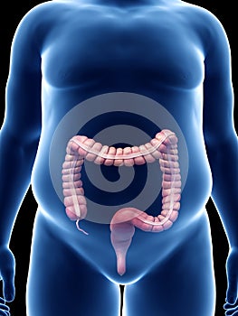 An obese guys colon