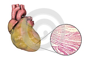 Obese heart, illustration