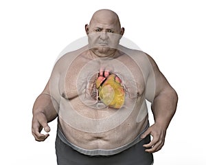 Obese heart in overweight man, 3D illustration. Concept of obesity and inner organs disease