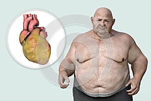 Obese heart in overweight man, 3D illustration. Concept of obesity and inner organs disease