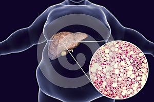 Obese man with fatty liver