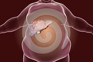 Obese man with fatty liver photo