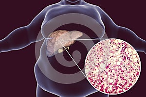 Obese man with fatty liver photo