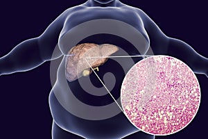 Obese man with fatty liver photo