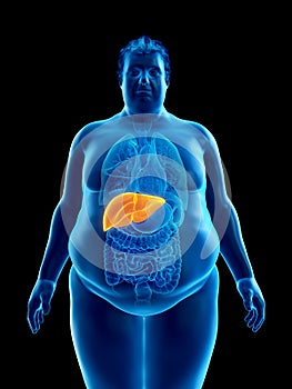 An obese mans liver