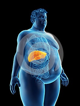 An obese mans liver