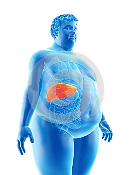 An obese mans liver