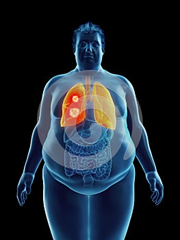 An obese mans lung tumor