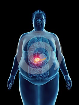 An obese mans pancreas tumor