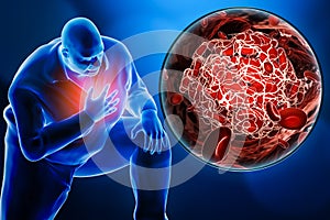 Obese or overweight man suffering a heart attack or a pulmonary embolism with a close-up image of a blood clot 3D rendering