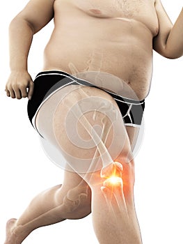 An obese runners painful knee