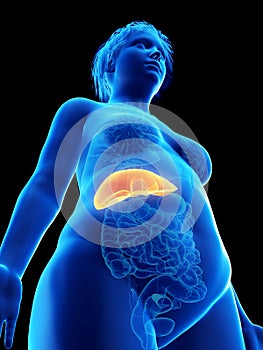 An obese womans liver