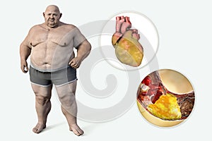 Obesity and atherosclerosis, 3D illustration. Atheromatous plaque inside artery of obese heart leading to narrowing of