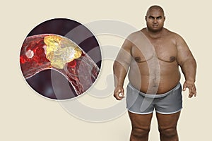 Obesity and atherosclerosis, conceptual 3D illustration. Atheromatous plaque inside artery leading to narrowing of blood